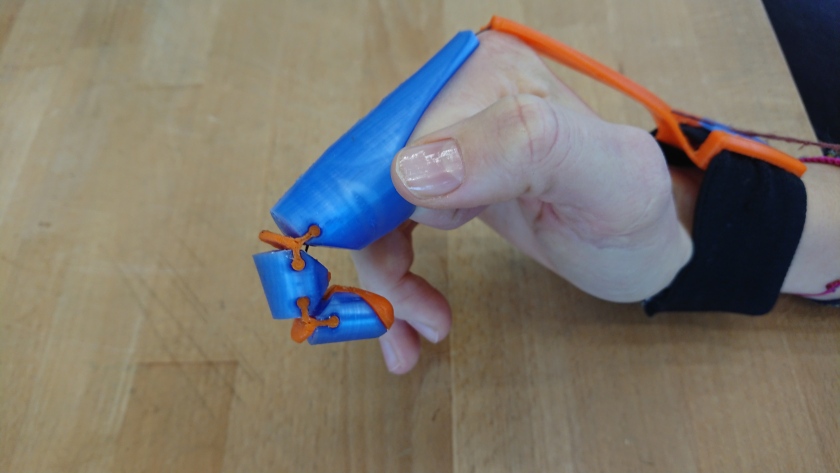 Hand mit Finger-Prothese aus dem 3D-Drucker